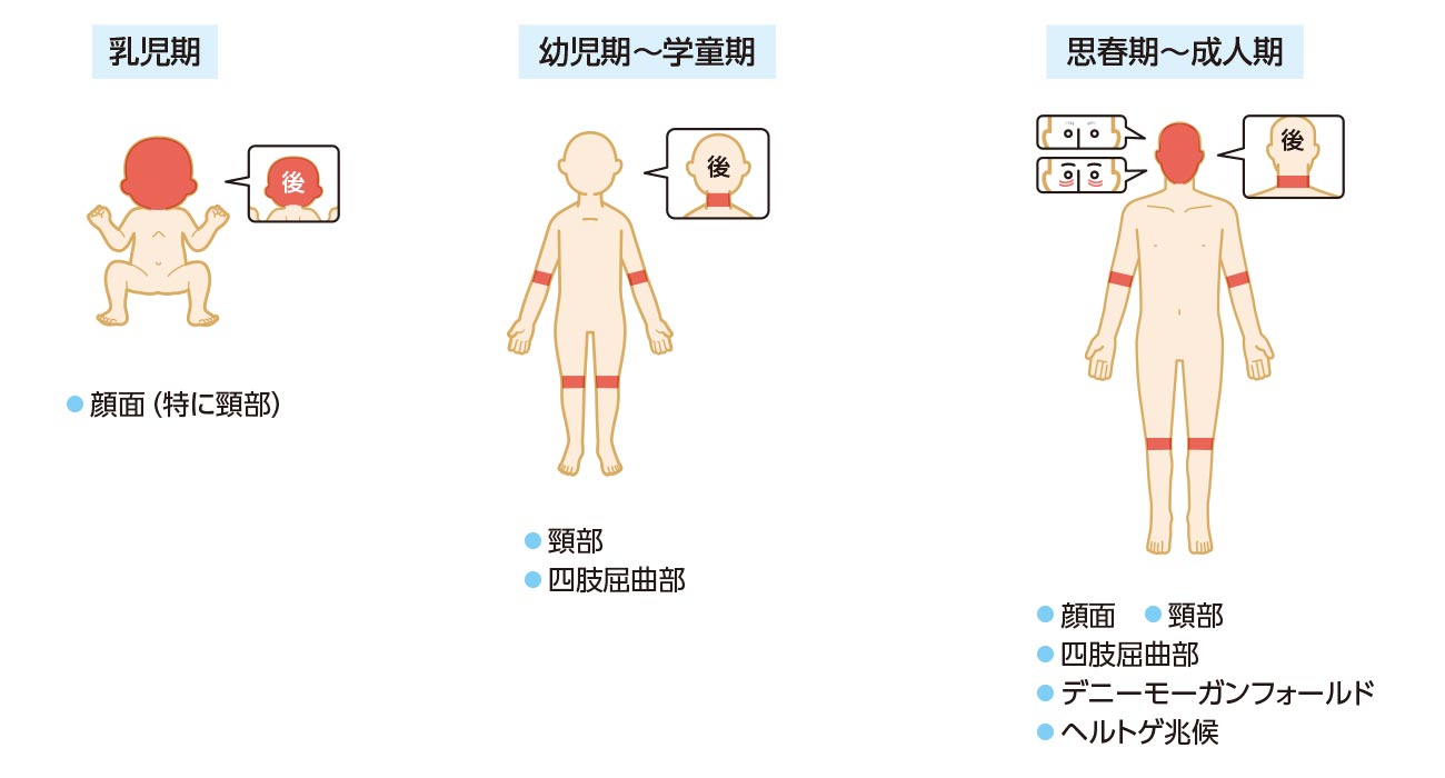 年齢別の好発部位の推移