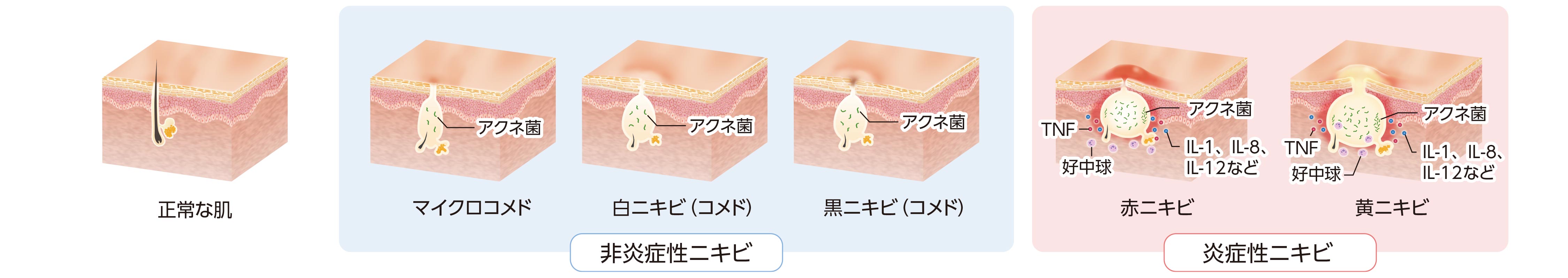 ニキビの種類と進行段階を示した解剖図