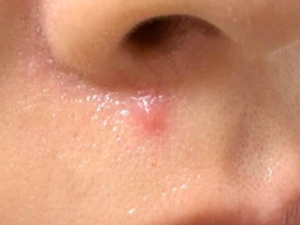 炎症を起こして赤く腫れた赤ニキビ